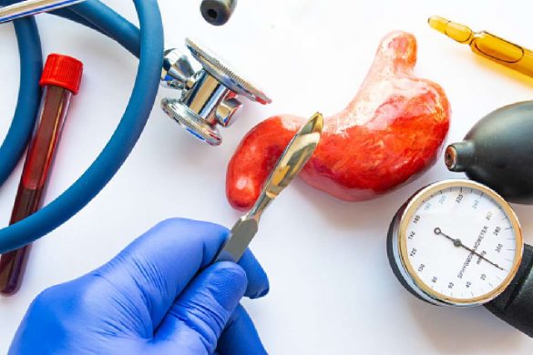 Gastric Bypass