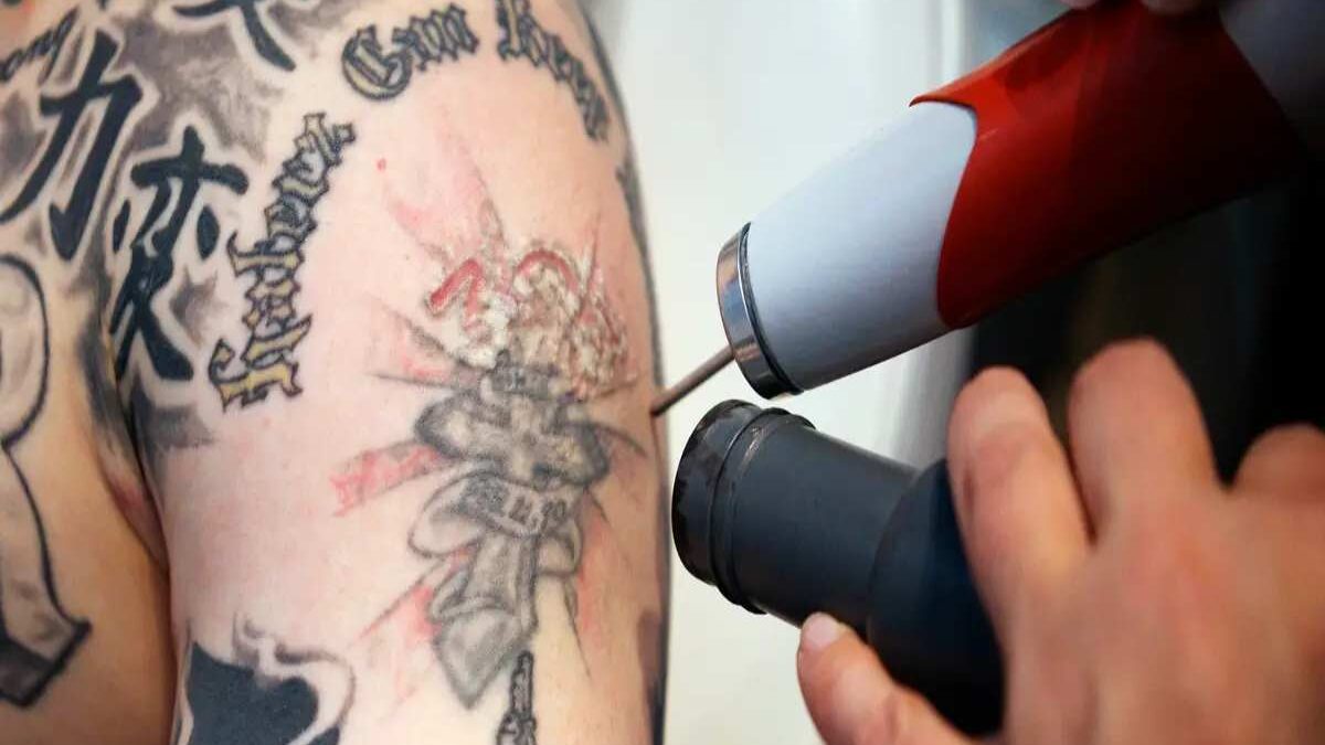 Can You Get a Tattoo Over Removed Skin? Expert Advice