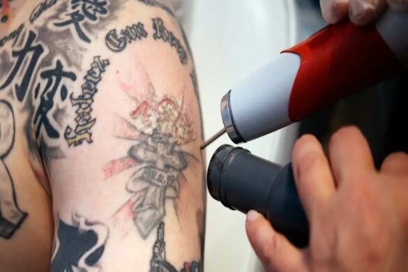 Tattoo Over Removed Skin